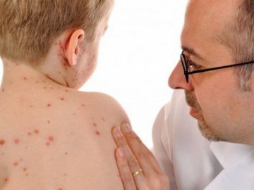 Захворюваність на кір на Волині зменшилася на 40%