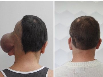 Рік потому: відомий хірург з Волині видалив з голови чоловіка велетенську пухлину