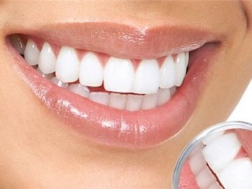 Встановлення вінірів: запитання та відповіді*