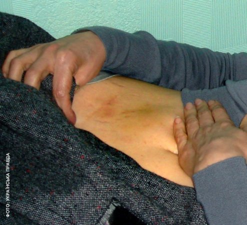 Тимошенко показала свої синці