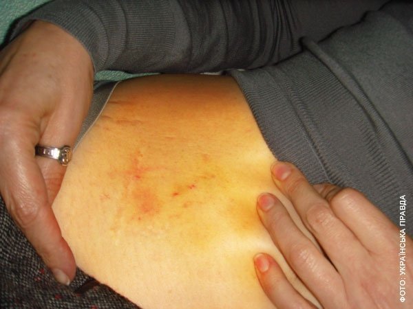 Тимошенко показала свої синці