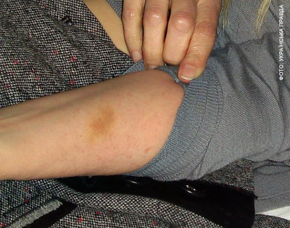 Тимошенко показала свої синці