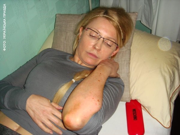 Тимошенко показала свої синці