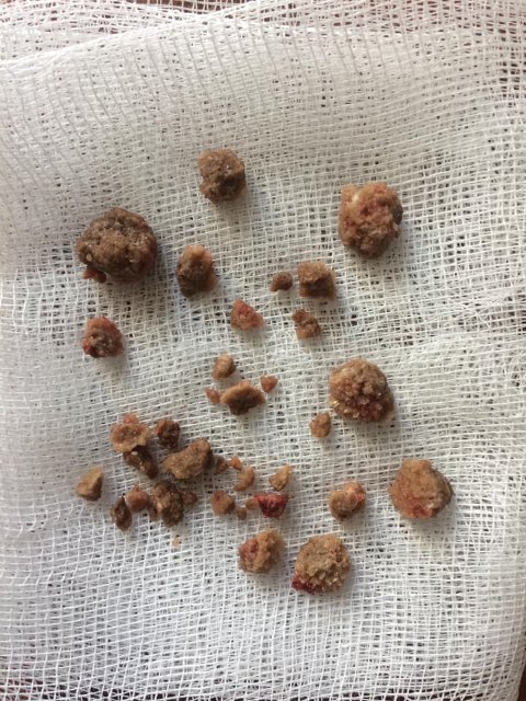 Ковельські лікарі видалили пацієнту камені з нирок через невеликий розріз