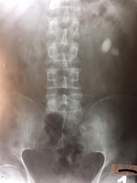 Ковельські лікарі видалили пацієнту камені з нирок через невеликий розріз