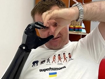 Воїну з Волині встановили сучасний біонічний протез руки