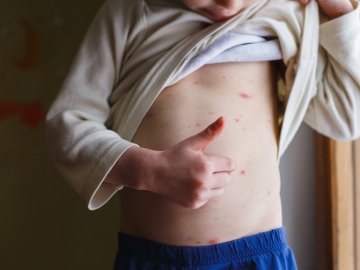 У МОЗ оцінили ризик розповсюдження мавпячої віспи в Україні