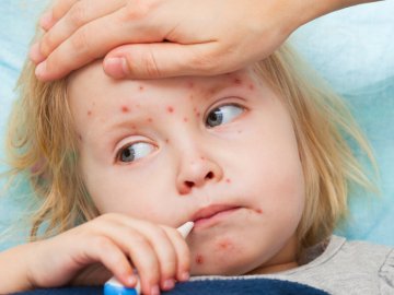 В Україні прогнозують епідемію кору