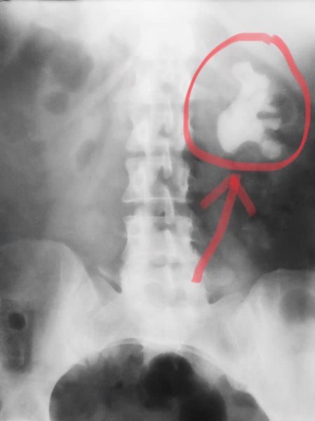 Волинські медики провели п'ять технічно найскладніших операцій в урології. ФОТО
