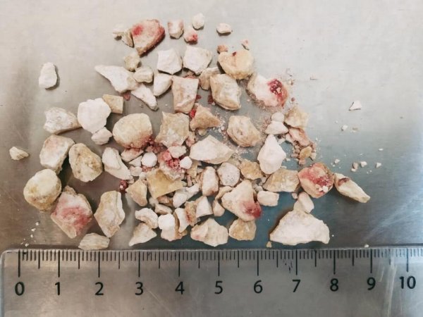 Волинські медики провели п'ять технічно найскладніших операцій в урології. ФОТО