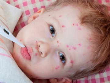 У дитсадку на Волині дитина захворіла на кір