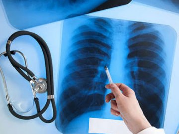 На Волині знизилася захворюваність на туберкульоз 