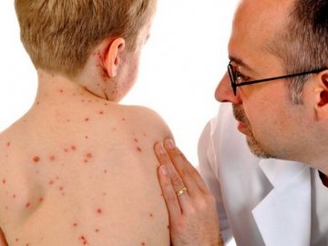 На кір у Нововолинську захворіло 10-місячне немовля