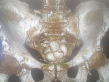 Волинські медики видалили 12 великих каменів із сечового міхура пацієнта