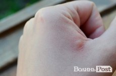 Наслідки від укусу мошки на третій день