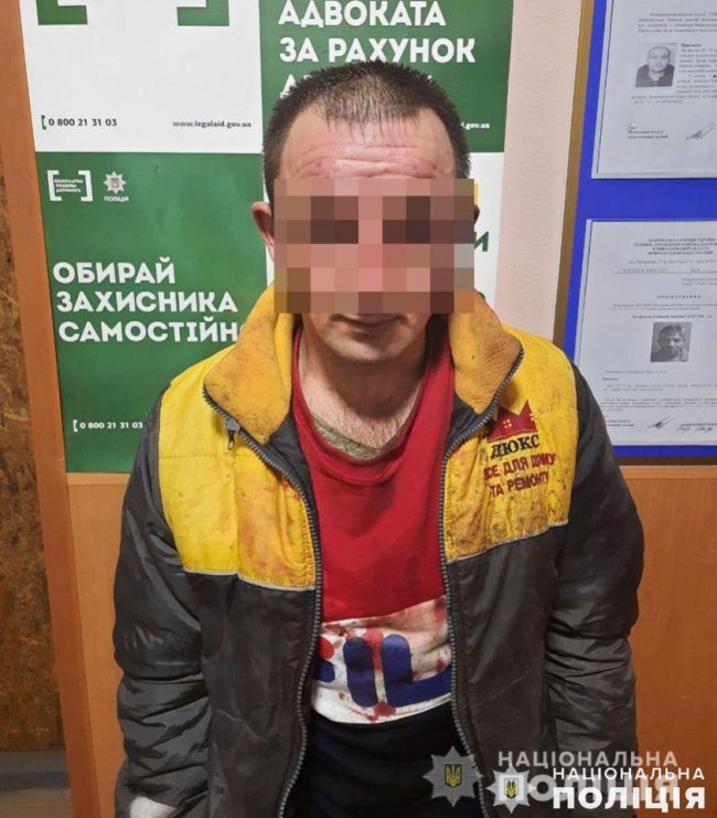 У Миколаєві чоловік облив кислотою дружину і двох дітей: постраждалі –  у лікарні із глибокими опіками