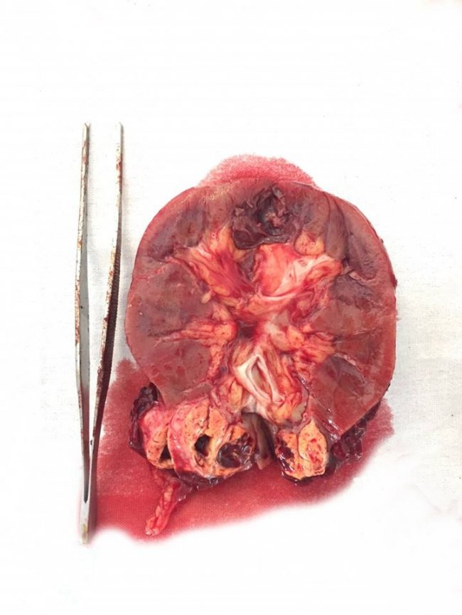 На Волині медики вирізали пацієнту уражену пухлиною нирку. ФОТО 18+