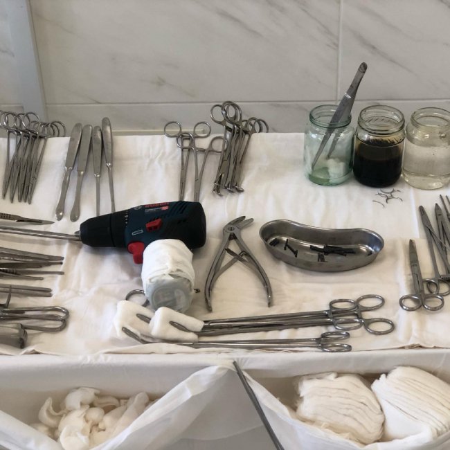 Гра у теніс закінчилася травмою: лікарі успішно прооперували руку волинянину