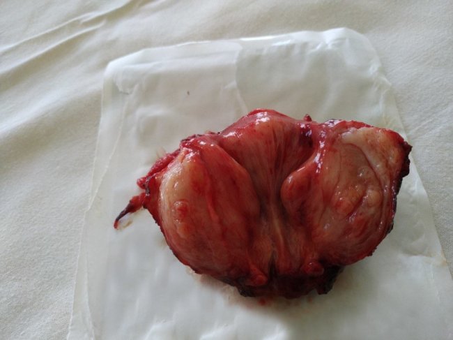 У Ковелі зробили найскладнішу операцію в онкоурології. ФОТО 18+