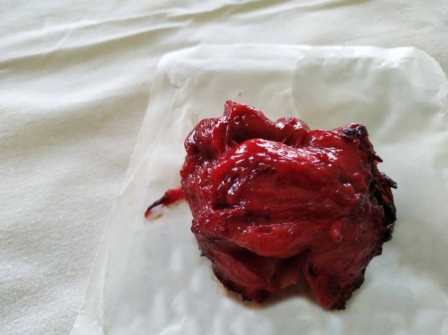 У Ковелі зробили найскладнішу операцію в онкоурології. ФОТО 18+