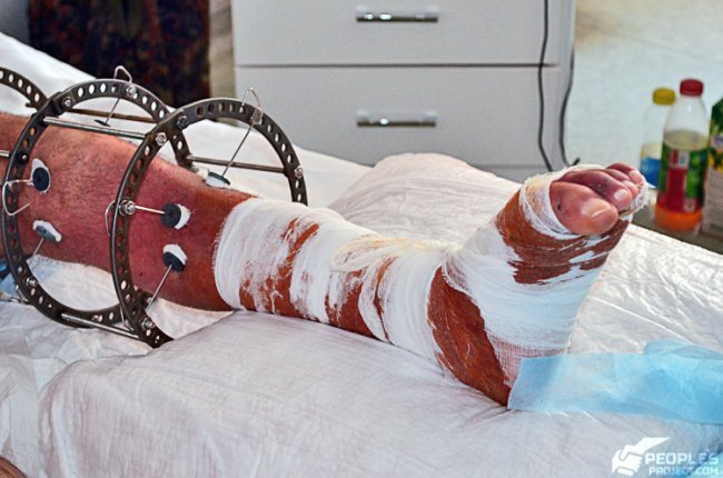 Терміново прооперували волинського бійця, який підірвався на розтяжці