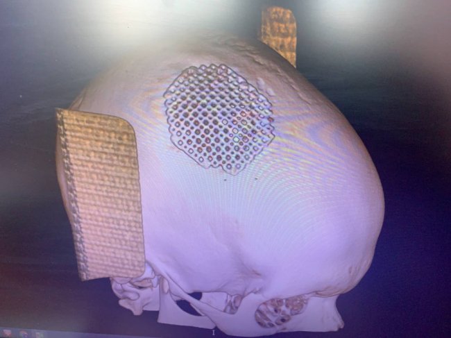 Рівненські лікарі встановили в череп 15-річному волинянину титанову пластину