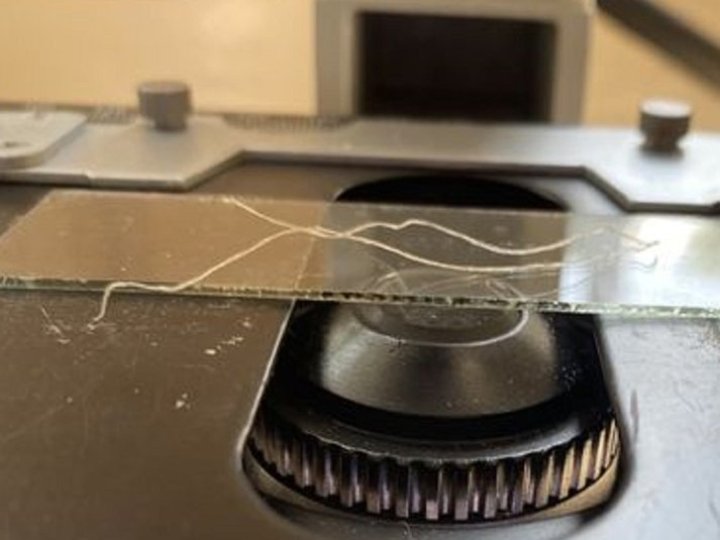 У волинянки виявили інфекційне захворювання, яке спричинив укус комара