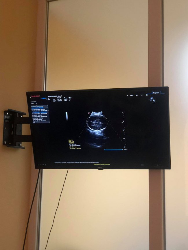 Для луцького пологового будинку придбали ультрасучасний УЗД апарат. ФОТО