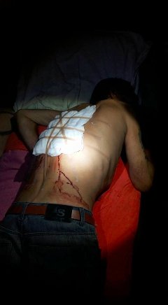 Лучанин ножицями пробив легеню кривднику. ФОТО