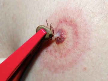 Волинянка відпочивала на річці і «підчепила» небезпечну недугу