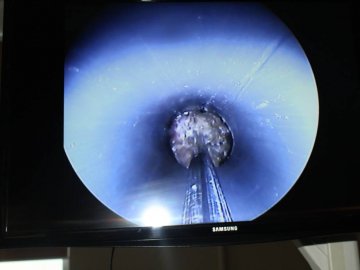 Ковельські лікарі видалили пацієнту камені з нирок через невеликий розріз