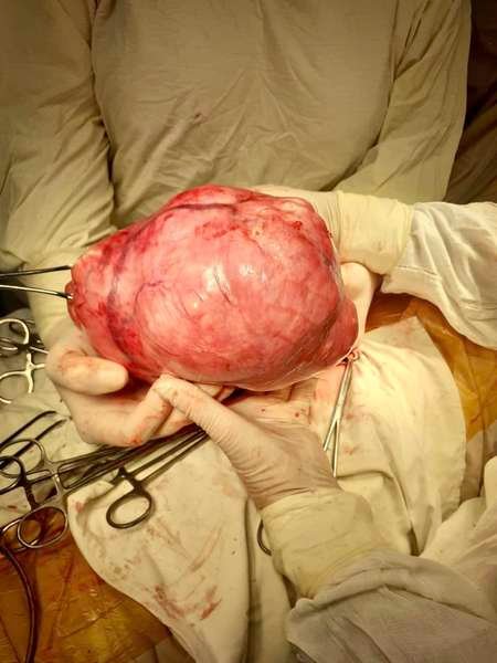 У Луцькій лікарні жінці видалили шестикілограмову пухлину 