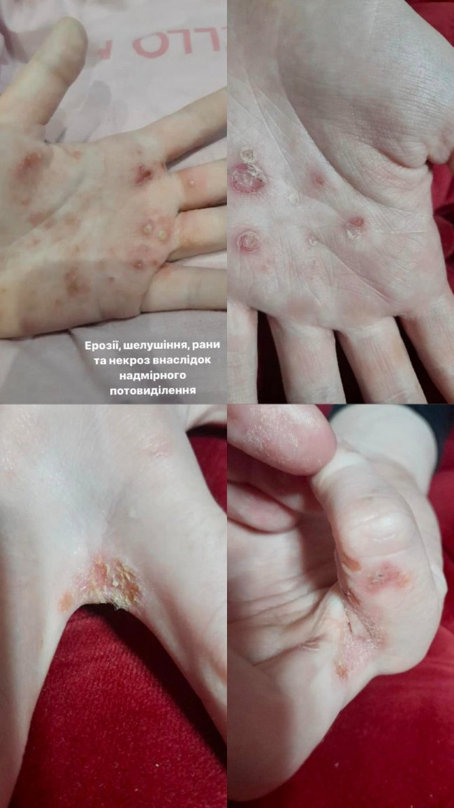 Львівські лікарі прооперували 13-річну волинянку з надмірним потовиділенням рук та стоп