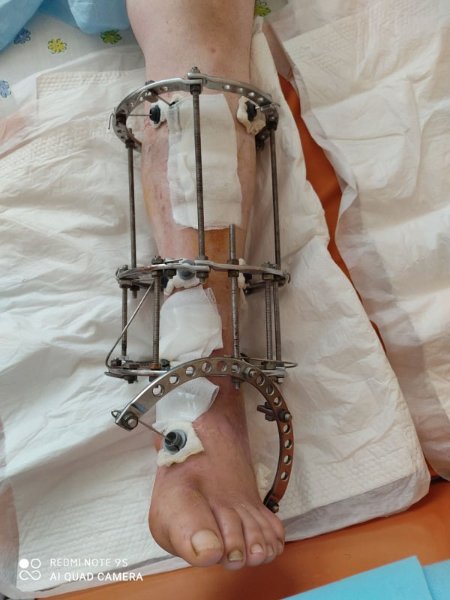 Волинські лікарі провели складну операцію чоловіку, який впав з вишні. ФОТО