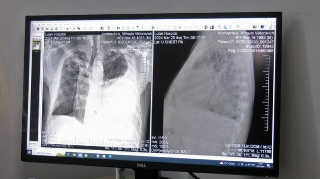 Кількість діагностованих випадків туберкульозу у дітей на Волині зросла у 5 разів