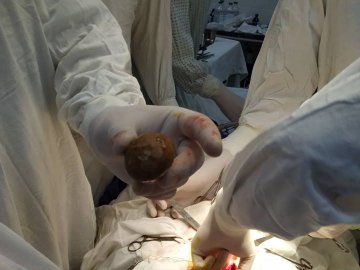 Волинські медики провели надскладну операцію з видалення величезних каменів з сечового міхура. ФОТО