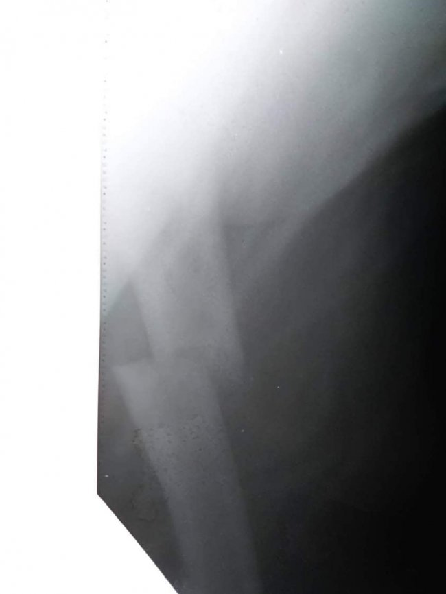 Волинські лікарі провели складну операцію жителю Рівненщини, який впав і тяжко травмувався