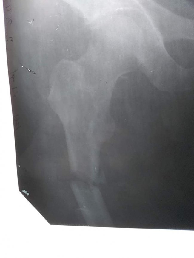 Волинські лікарі провели складну операцію жителю Рівненщини, який впав і тяжко травмувався