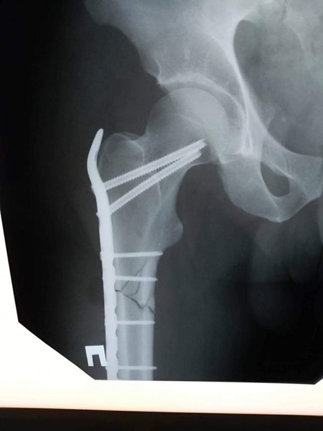 Волинські лікарі провели складну операцію жителю Рівненщини, який впав і тяжко травмувався