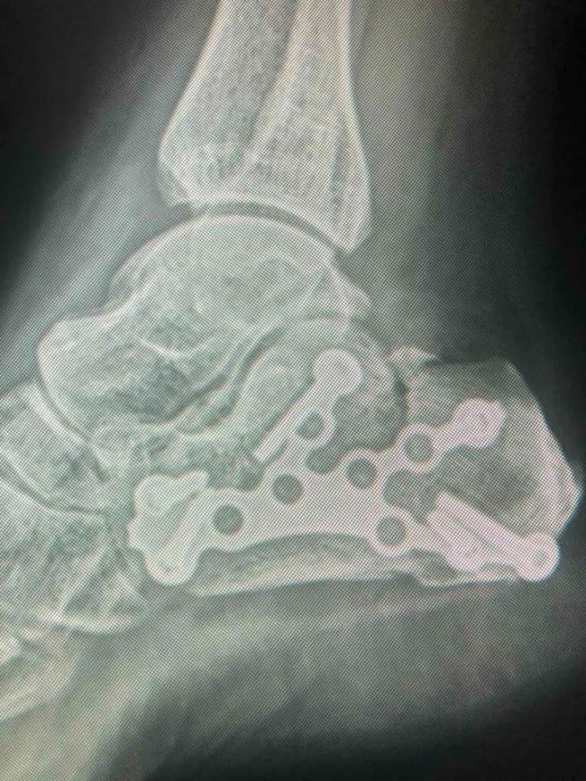 Клеїла шпалери і впала з табуретки: волинські лікарі врятували жінці ногу. ФОТО