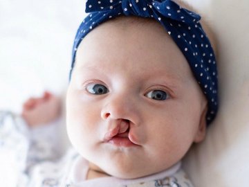 Хірург з Волині Валіхновський безкоштовно прооперував маленьку дівчинку