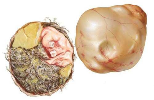 Волинські хірурги видалили жінці пухлину із «сюрпризом». ФОТО 18+