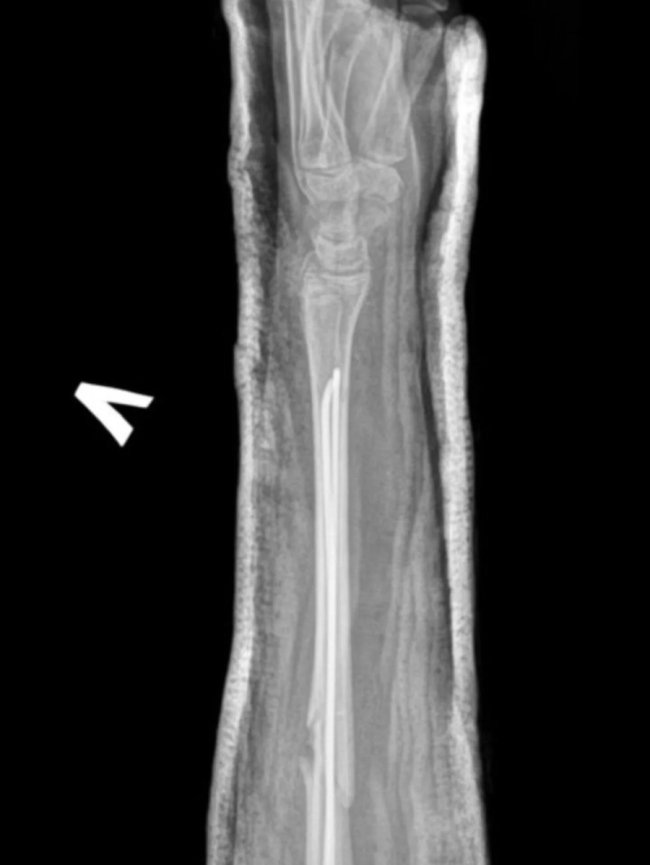 На Волині лікарі зробили унікальну операцію без жодного розрізу. ФОТО