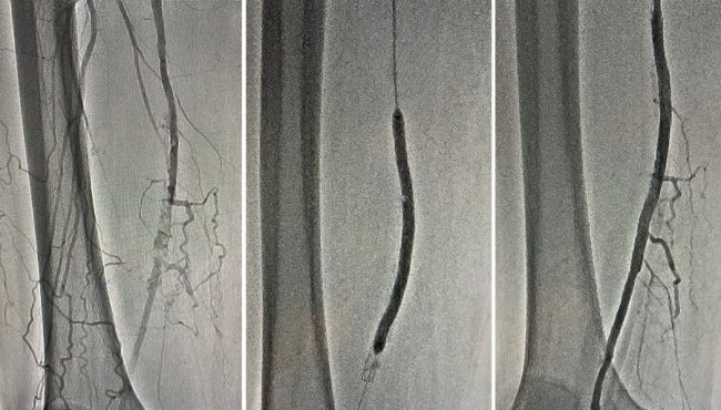 Волинські лікарі врятували ноги чоловіка від ампутації 