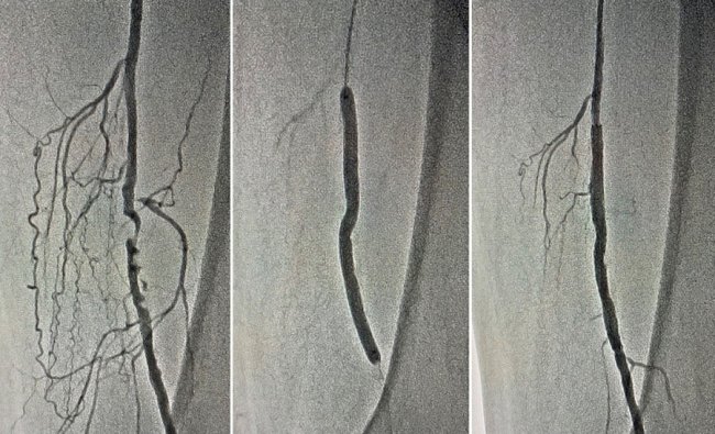 Волинські лікарі врятували ноги чоловіка від ампутації 