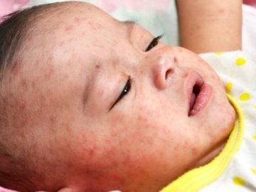 Кір з України спричинив спалах у США, – ЗМІ