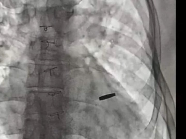 З серця звільненого з полону захисника «Азовсталі» дістали кулю, з якою він прожив 3 роки