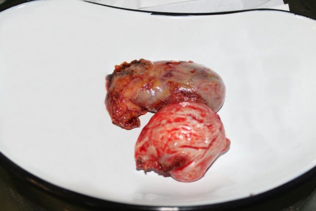 Волинські лікарі видалили пухлину і врятували життя жінці. ФОТО 18+