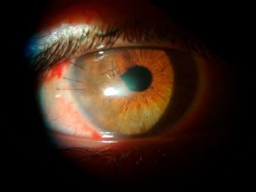 В обласній лікарні Волині врятували око пацієнтові, що травмувався при роботі з «болгаркою»