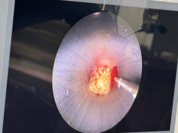 У волинянки камінь у нирках лікарі вирізали лазером